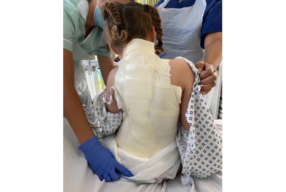 Julies scoliosis story after surgery.jpg