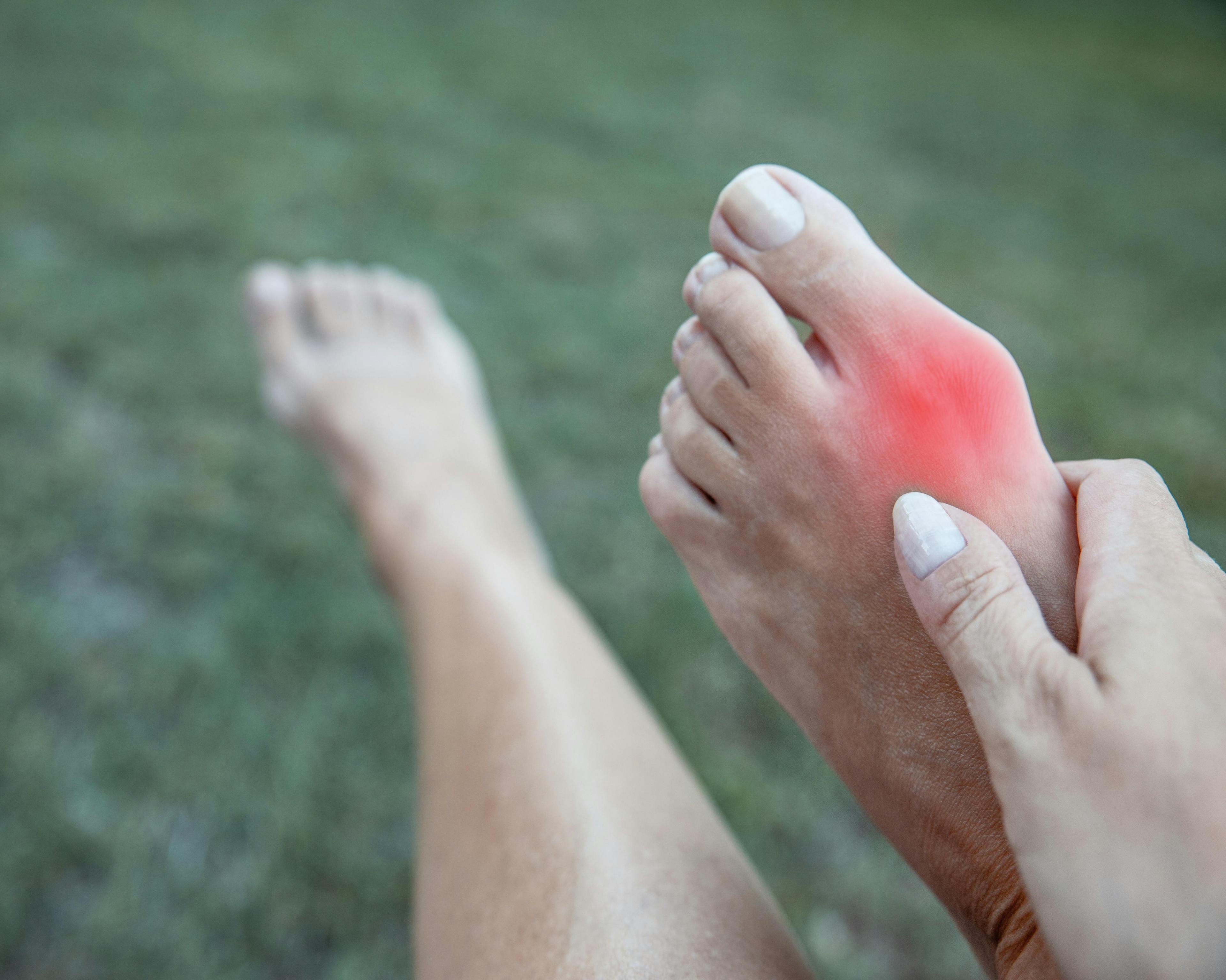 Your questions about bunions answer bunion-xray foot and ankle orthopaedics 1312682593.jpg